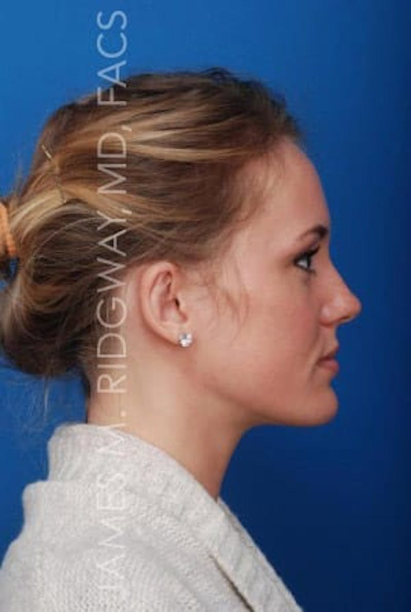 Ear Surgery (Otoplasty) Before & After Gallery - Patient 149049749 - Image 6