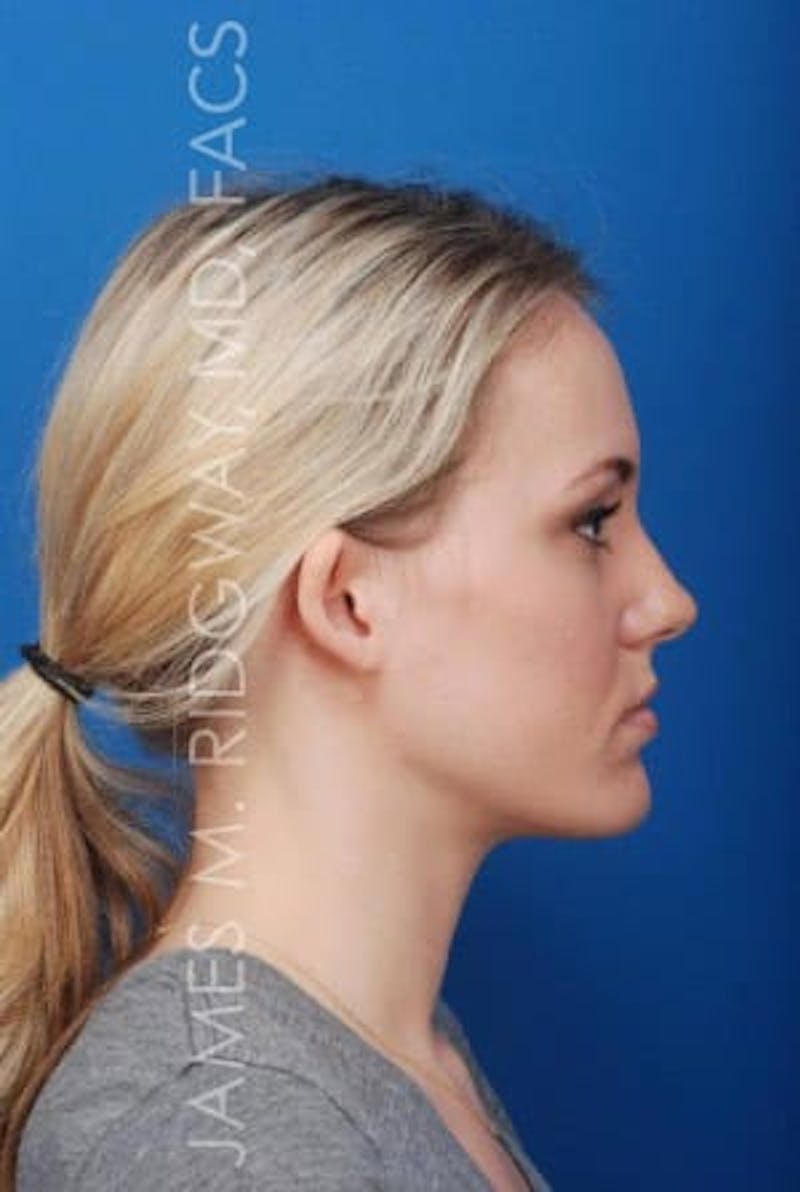 Ear Surgery (Otoplasty) Before & After Gallery - Patient 149049749 - Image 5