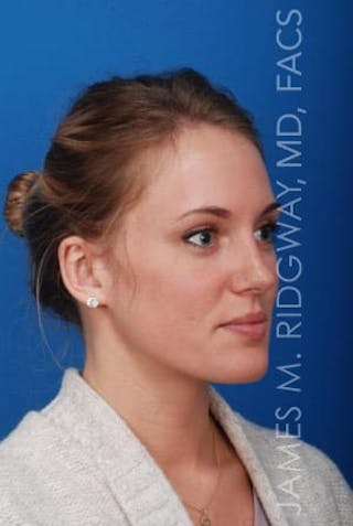 Ear Surgery (Otoplasty) Before & After Gallery - Patient 149049749 - Image 8