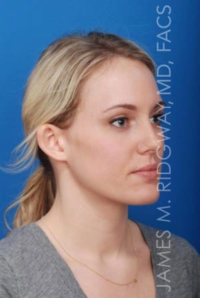 Ear Surgery (Otoplasty) Before & After Gallery - Patient 149049749 - Image 7