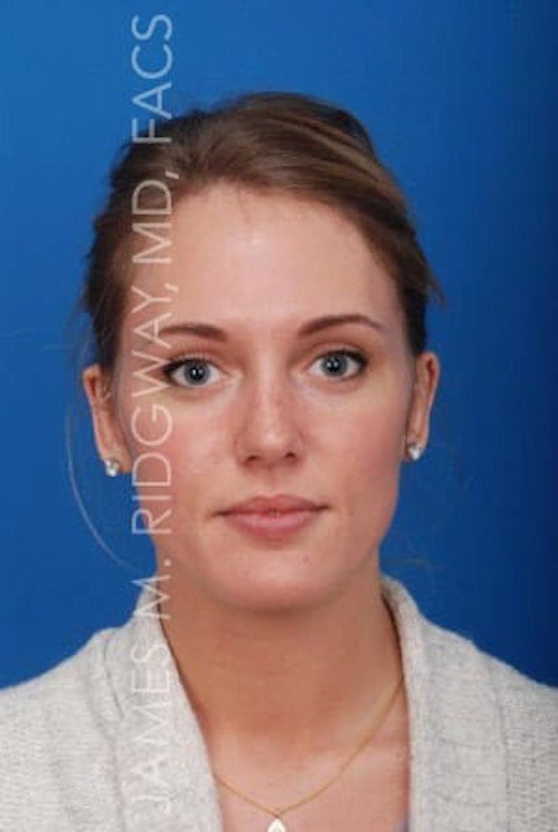 Ear Surgery (Otoplasty) Before & After Gallery - Patient 149049749 - Image 10