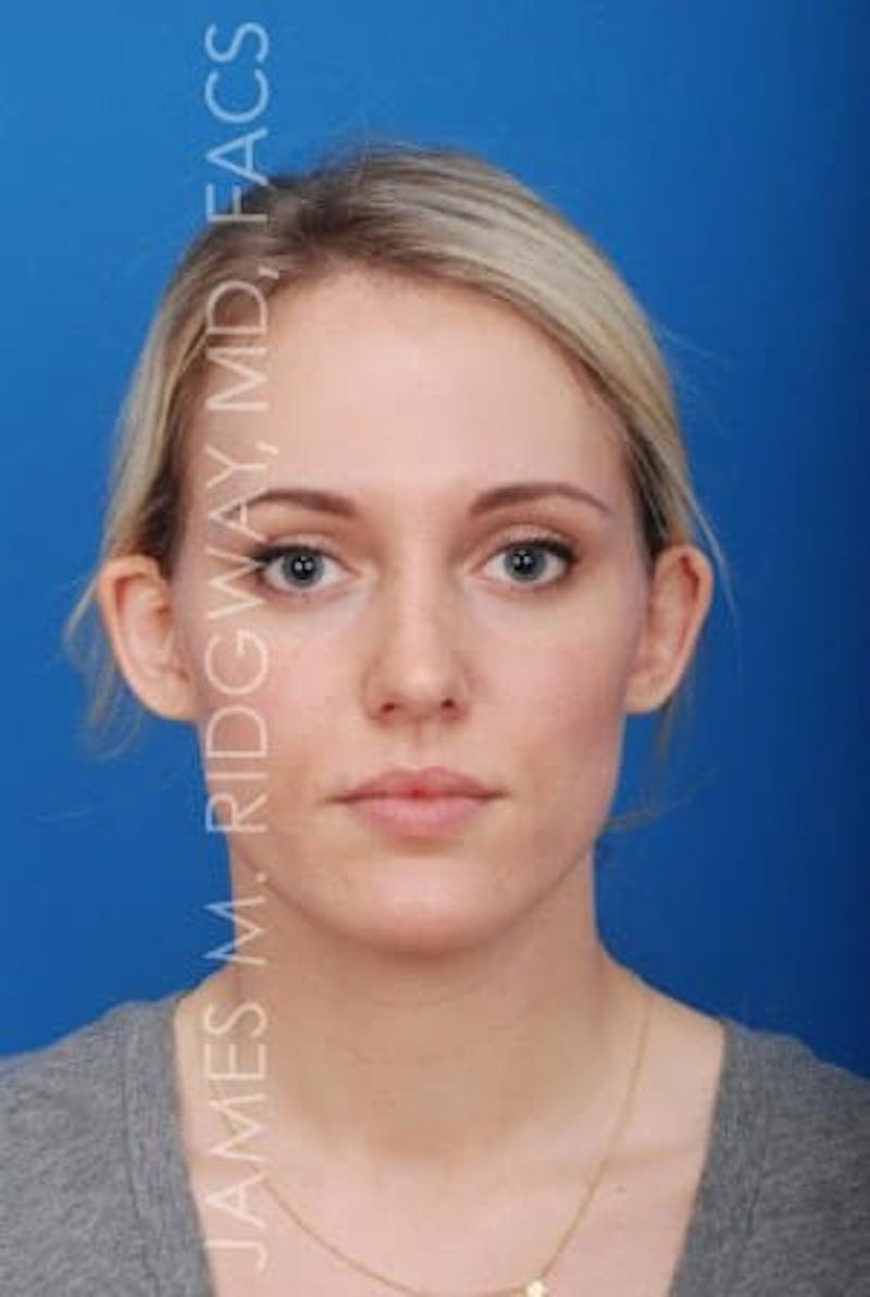 Ear Surgery (Otoplasty) Before & After Gallery - Patient 149049749 - Image 9