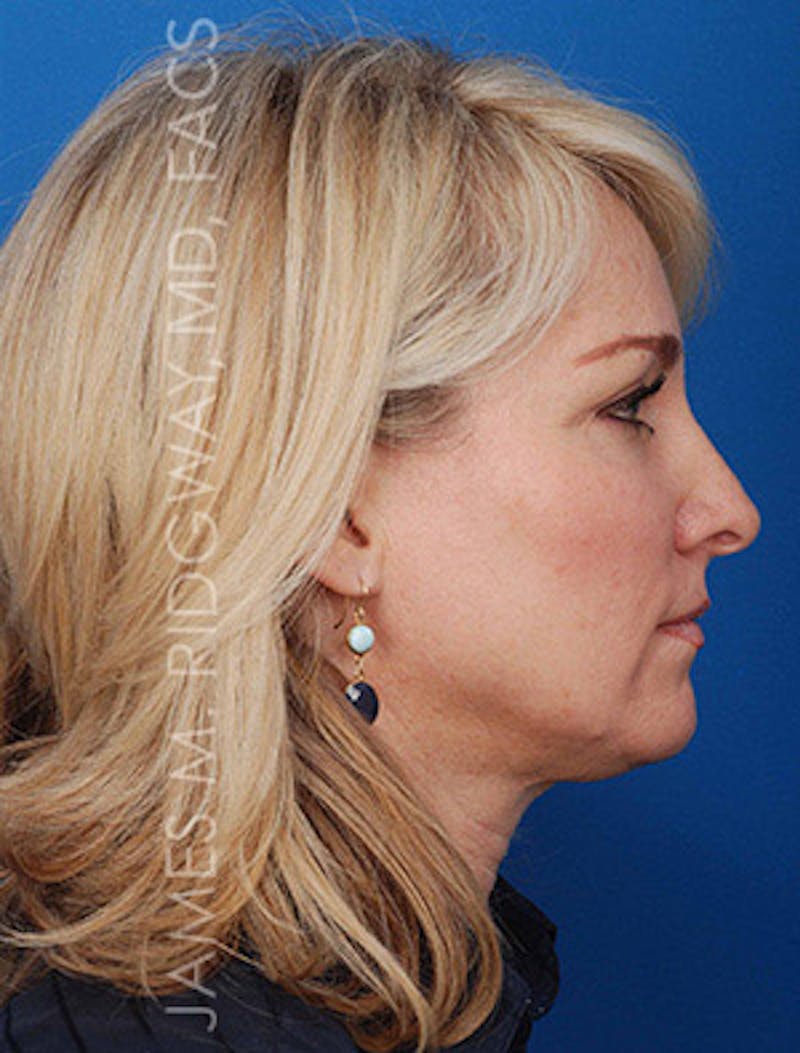 Facial Surgery (Facelift) Before & After Gallery - Patient 185057704 - Image 5
