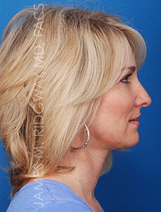 Facial Surgery (Facelift) Before & After Gallery - Patient 185057704 - Image 6