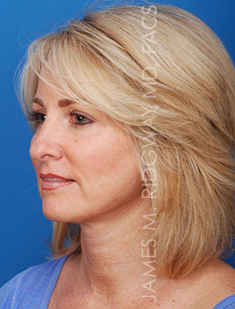 Facial Surgery (Facelift) Before & After Gallery - Patient 185057704 - Image 8