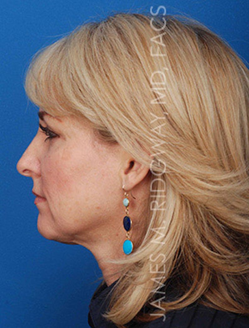 Facial Surgery (Facelift) Before & After Gallery - Patient 185057704 - Image 9