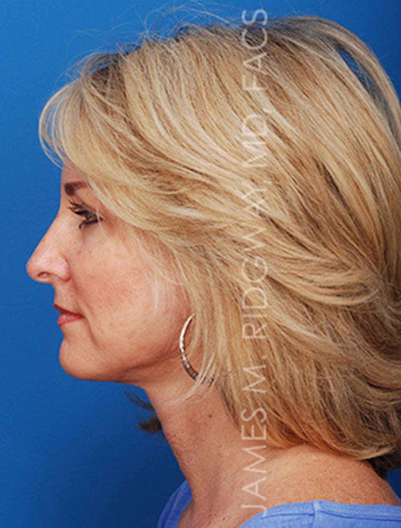 Facial Surgery (Facelift) Before & After Gallery - Patient 185057704 - Image 10