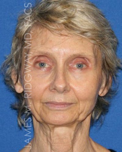 Facial Surgery (Facelift) Before & After Gallery - Patient 185057709 - Image 1