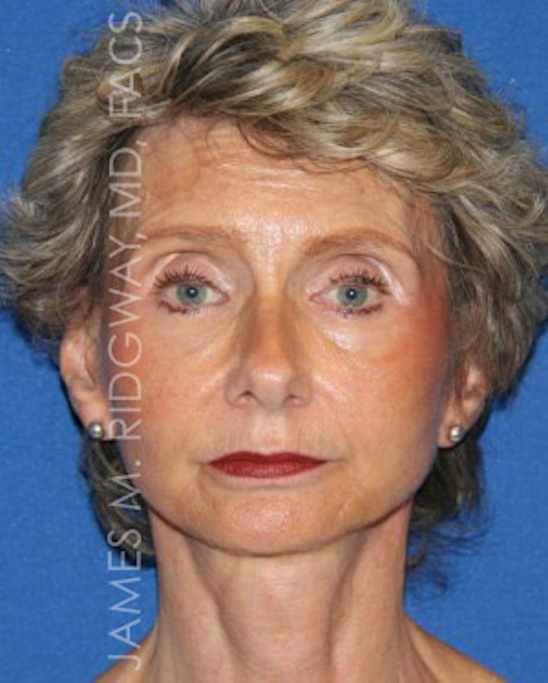 Facial Surgery (Facelift) Before & After Gallery - Patient 185057709 - Image 2