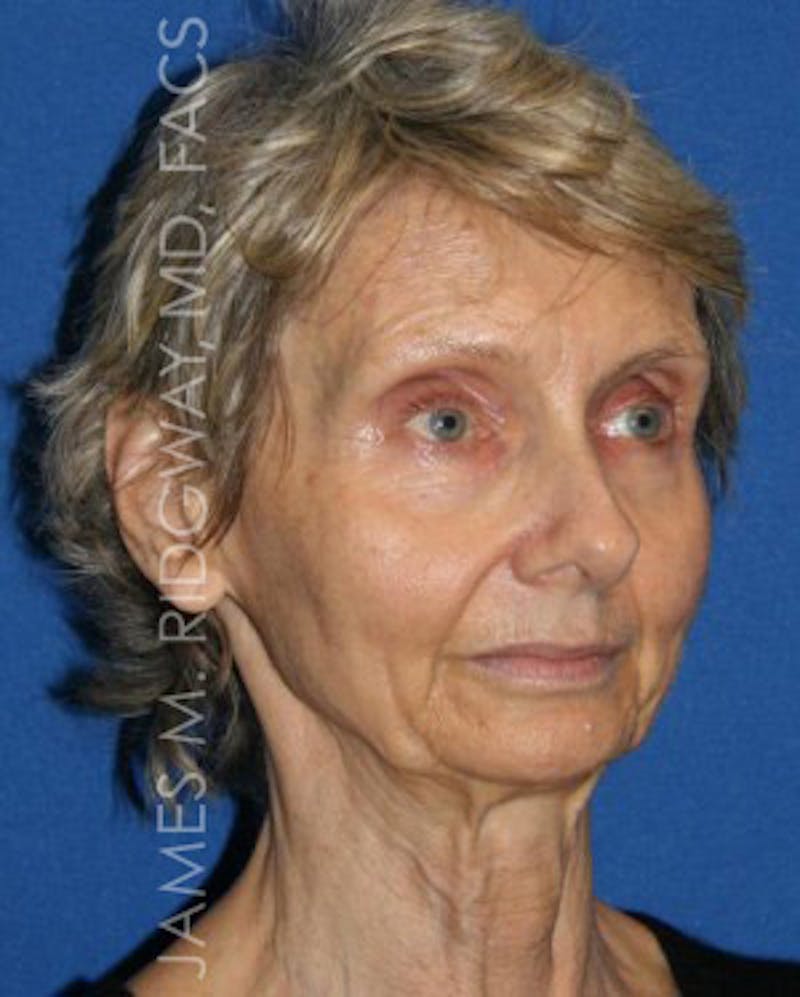 Facial Surgery (Facelift) Before & After Gallery - Patient 185057709 - Image 3