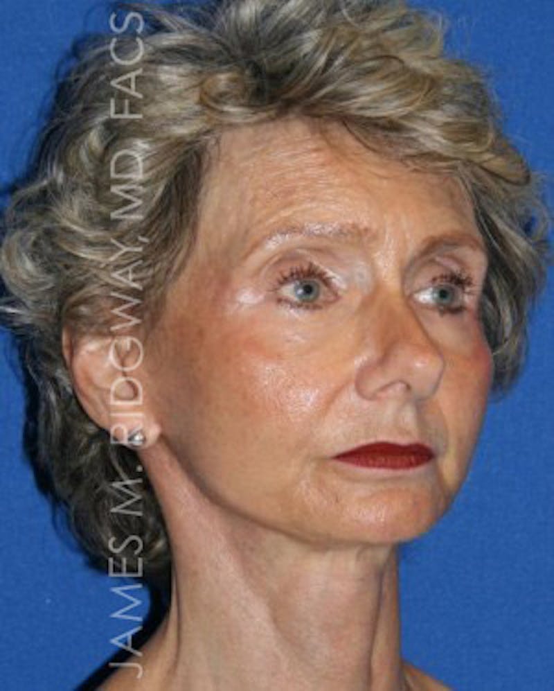 Facial Surgery (Facelift) Before & After Gallery - Patient 185057709 - Image 4