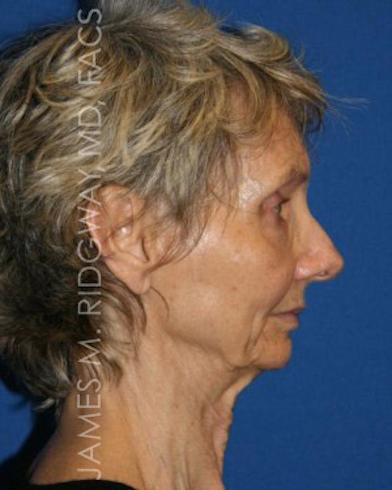Facial Surgery (Facelift) Before & After Gallery - Patient 185057709 - Image 5