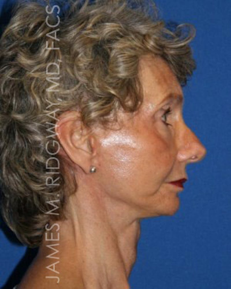 Facial Surgery (Facelift) Before & After Gallery - Patient 185057709 - Image 6