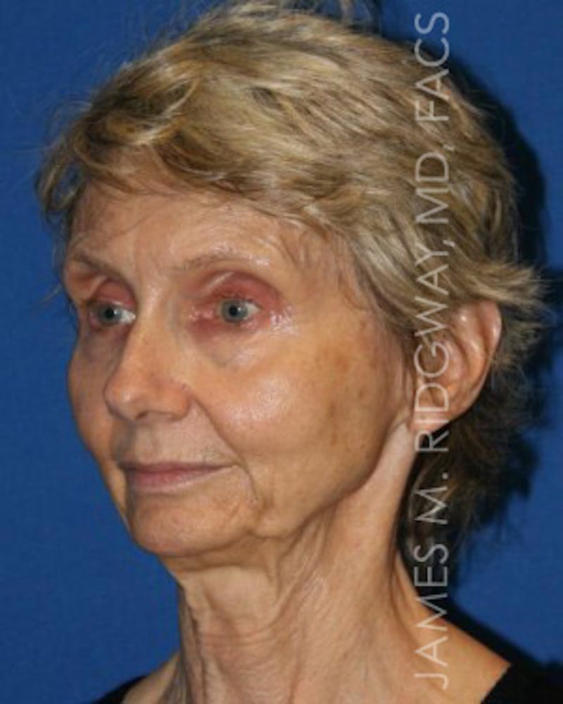 Facial Surgery (Facelift) Before & After Gallery - Patient 185057709 - Image 7