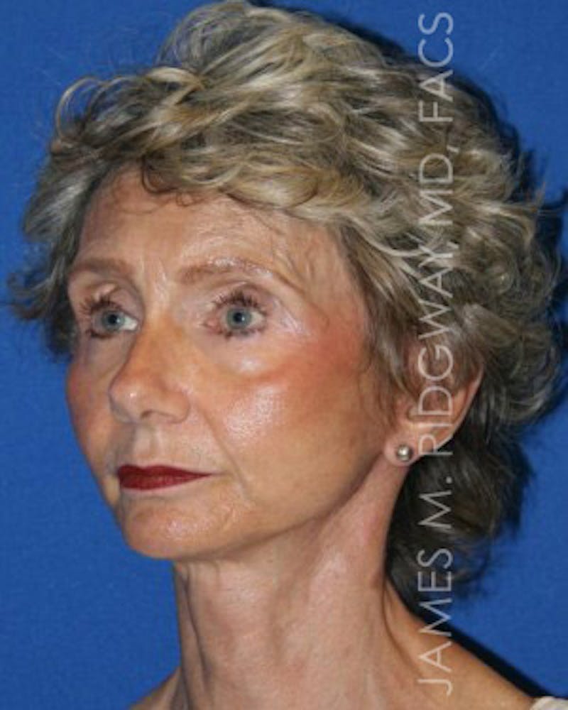 Facial Surgery (Facelift) Before & After Gallery - Patient 185057709 - Image 8