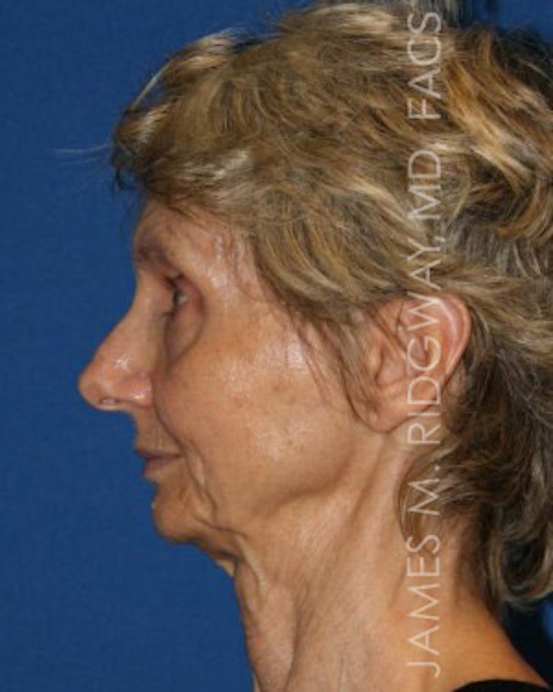 Facial Surgery (Facelift) Before & After Gallery - Patient 185057709 - Image 9