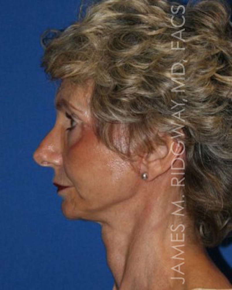 Facial Surgery (Facelift) Before & After Gallery - Patient 185057709 - Image 10