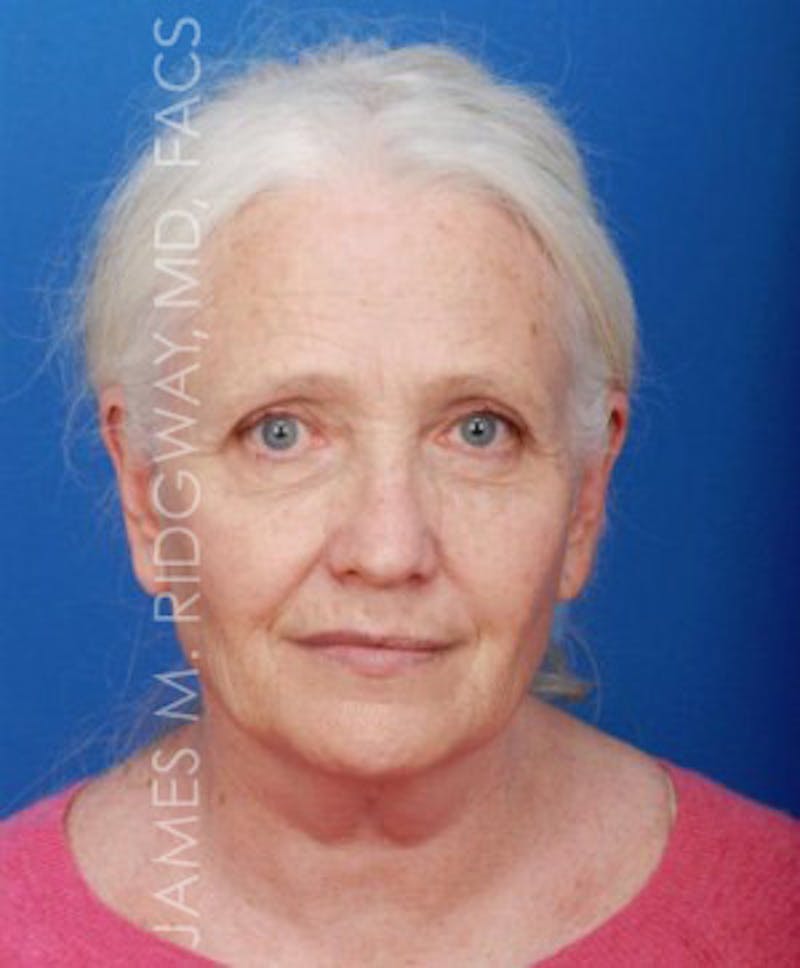 Facial Surgery (Facelift) Before & After Gallery - Patient 185057715 - Image 1