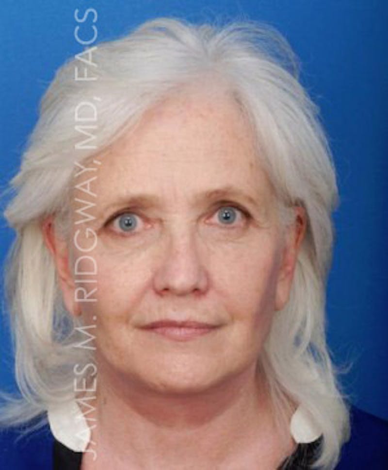 Facial Surgery (Facelift) Before & After Gallery - Patient 185057715 - Image 2