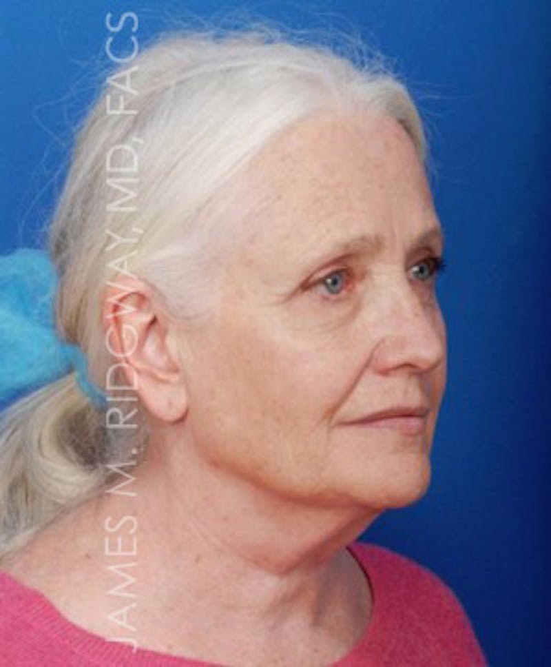 Facial Surgery (Facelift) Before & After Gallery - Patient 185057715 - Image 3
