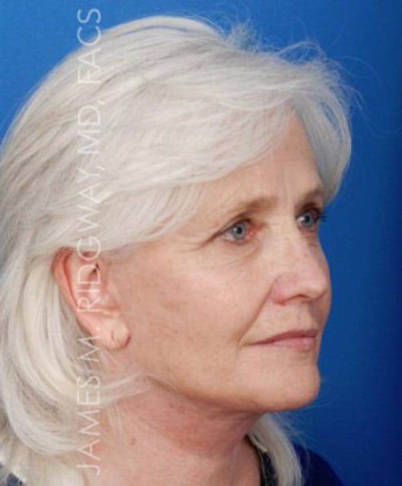 Facial Surgery (Facelift) Before & After Gallery - Patient 185057715 - Image 4