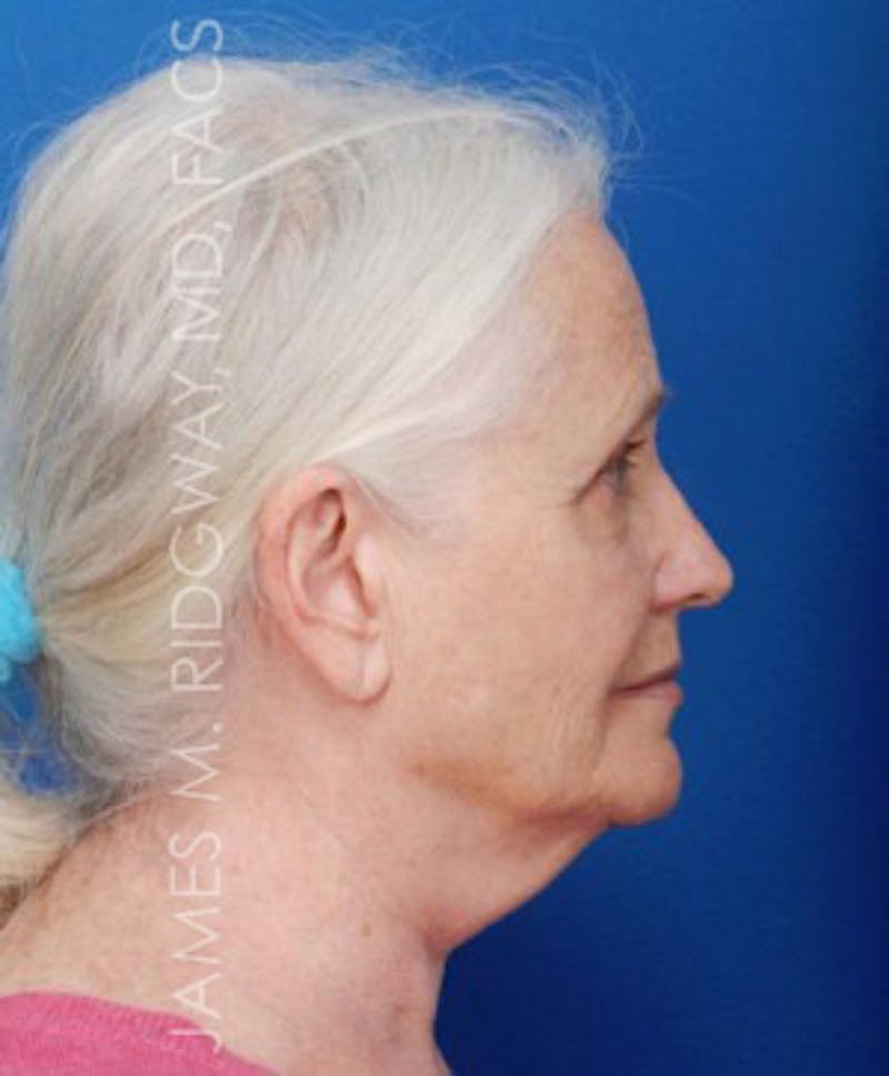 Facial Surgery (Facelift) Before & After Gallery - Patient 185057715 - Image 5