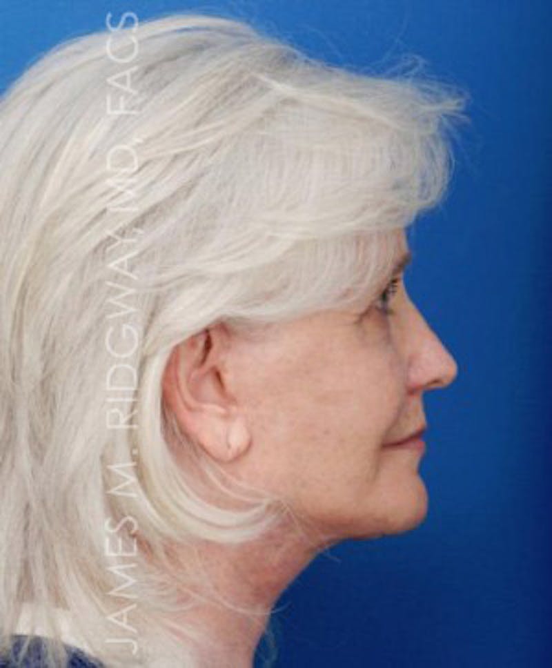 Facial Surgery (Facelift) Before & After Gallery - Patient 185057715 - Image 6