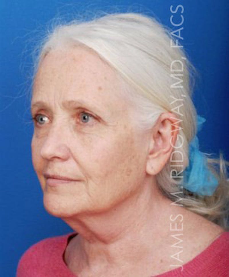 Facial Surgery (Facelift) Before & After Gallery - Patient 185057715 - Image 7