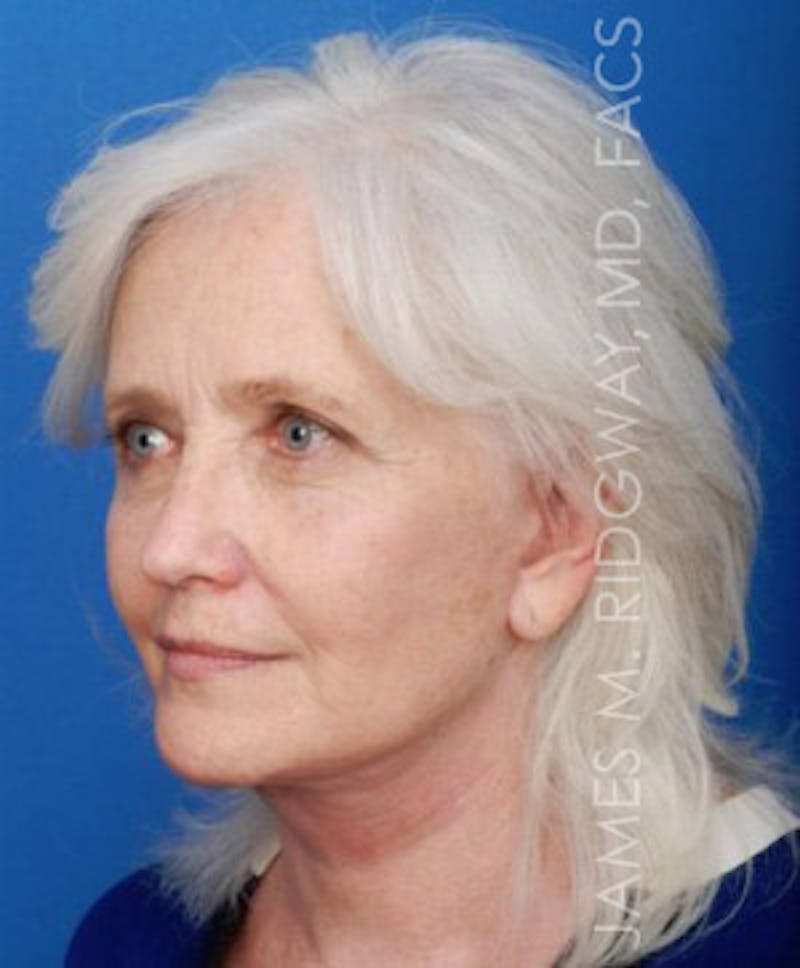 Facial Surgery (Facelift) Before & After Gallery - Patient 185057715 - Image 8