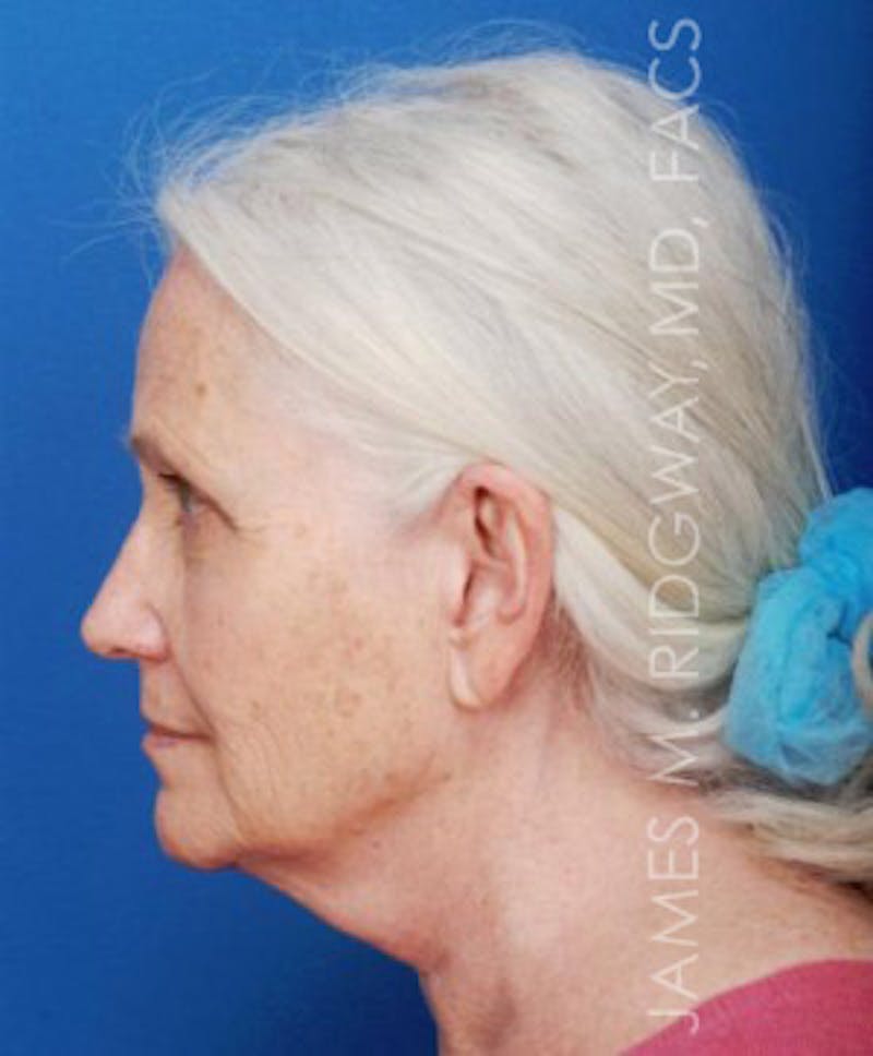 Facial Surgery (Facelift) Before & After Gallery - Patient 185057715 - Image 9