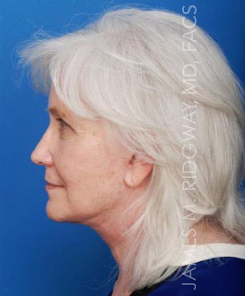 Facial Surgery (Facelift) Before & After Gallery - Patient 185057715 - Image 10