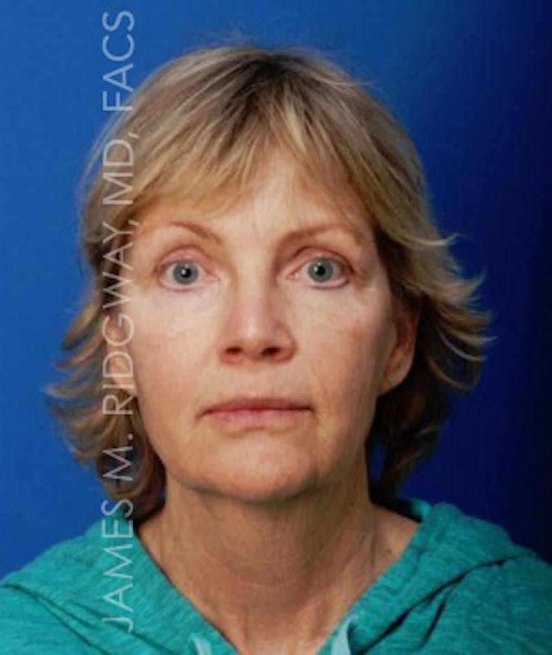 Facial Surgery (Facelift) Before & After Gallery - Patient 185057736 - Image 1