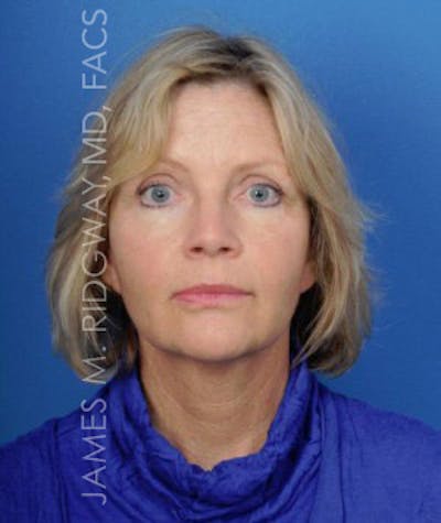 Facial Surgery (Facelift) Before & After Gallery - Patient 185057736 - Image 2