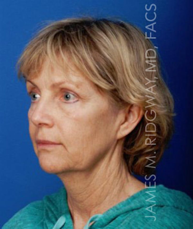 Facial Surgery (Facelift) Before & After Gallery - Patient 185057736 - Image 3