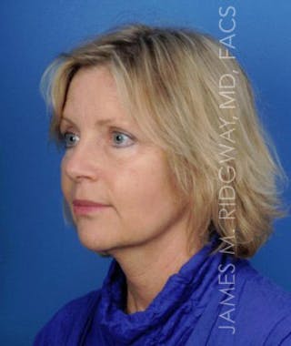 Facial Surgery (Facelift) Before & After Gallery - Patient 185057736 - Image 4