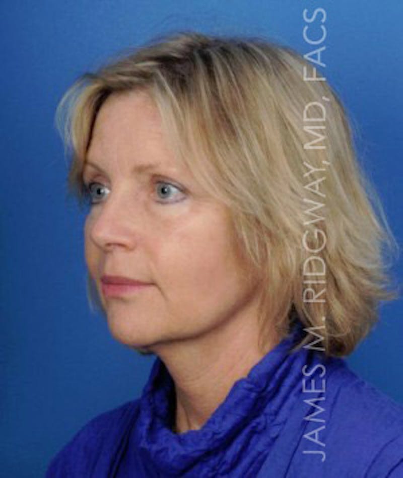 Facial Surgery (Facelift) Before & After Gallery - Patient 185057736 - Image 4