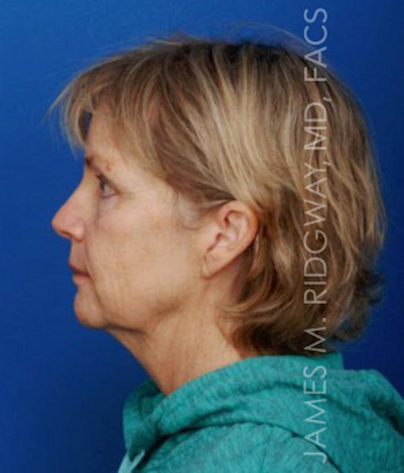 Facial Surgery (Facelift) Before & After Gallery - Patient 185057736 - Image 5