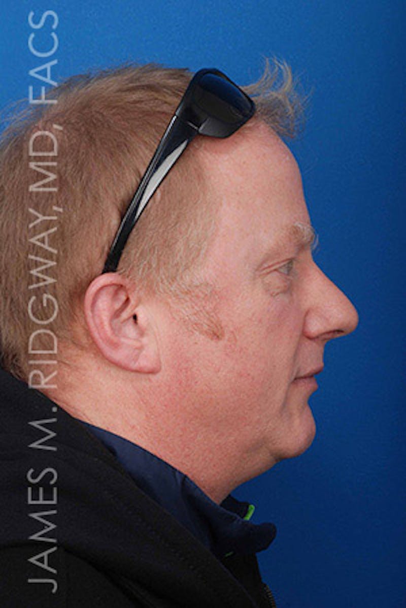 Nose Surgery (Rhinoplasty) Before & After Gallery - Patient 185057742 - Image 3