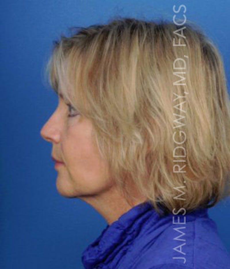 Facial Surgery (Facelift) Before & After Gallery - Patient 185057736 - Image 6