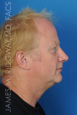 Nose Surgery (Rhinoplasty) Before & After Gallery - Patient 185057742 - Image 4