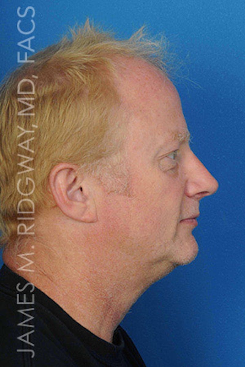 Nose Surgery (Rhinoplasty) Before & After Gallery - Patient 185057742 - Image 4