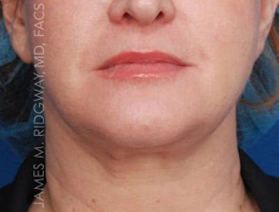Facial Surgery (Facelift) Before & After Gallery - Patient 185057739 - Image 1