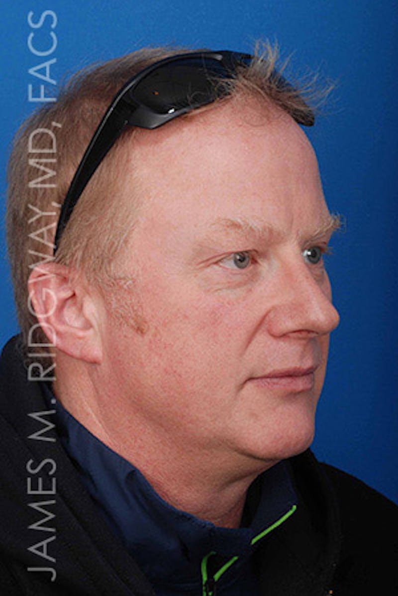 Nose Surgery (Rhinoplasty) Before & After Gallery - Patient 185057742 - Image 5