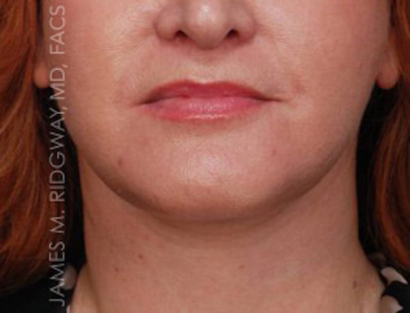 Facial Surgery (Facelift) Before & After Gallery - Patient 185057739 - Image 2
