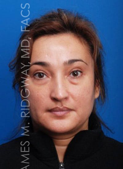 Eyelid Surgery (Blepharoplasty) Before & After Gallery - Patient 185057738 - Image 1
