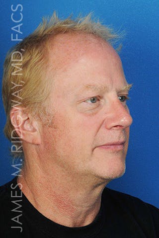 Nose Surgery (Rhinoplasty) Before & After Gallery - Patient 185057742 - Image 6