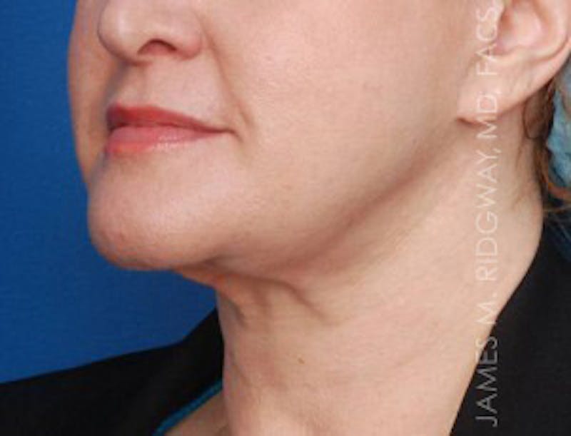 Facial Surgery (Facelift) Before & After Gallery - Patient 185057739 - Image 3