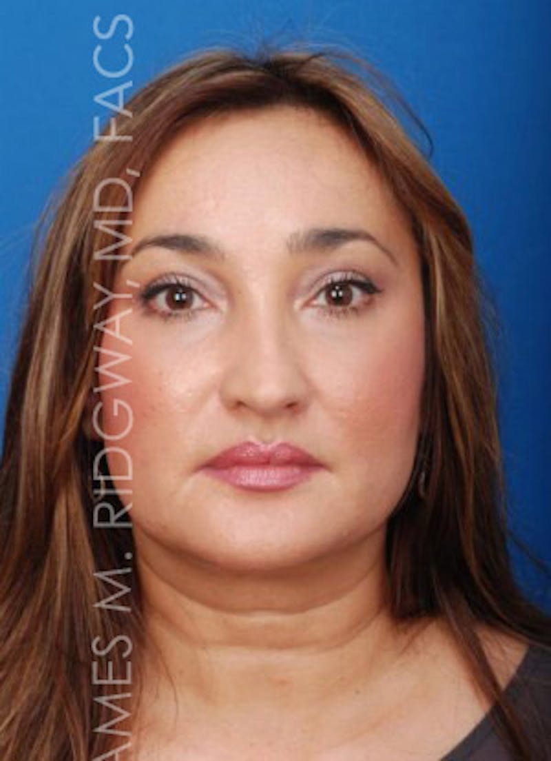 Eyelid Surgery (Blepharoplasty) Before & After Gallery - Patient 185057738 - Image 2
