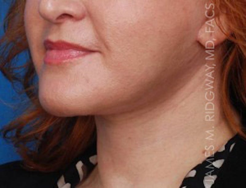 Facial Surgery (Facelift) Before & After Gallery - Patient 185057739 - Image 4