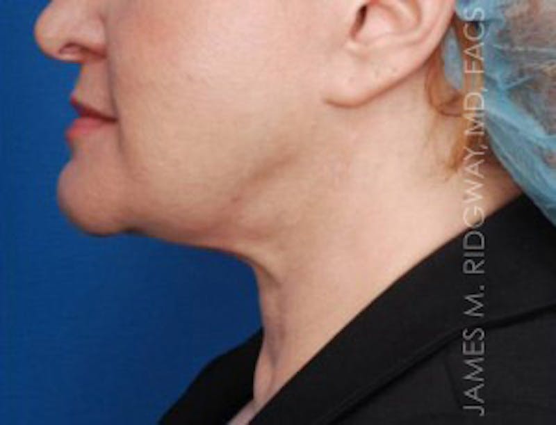 Facial Surgery (Facelift) Before & After Gallery - Patient 185057739 - Image 5